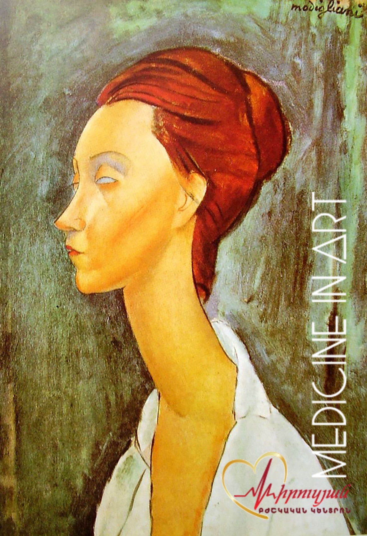 Մոդիլիանիի համախտանիշ