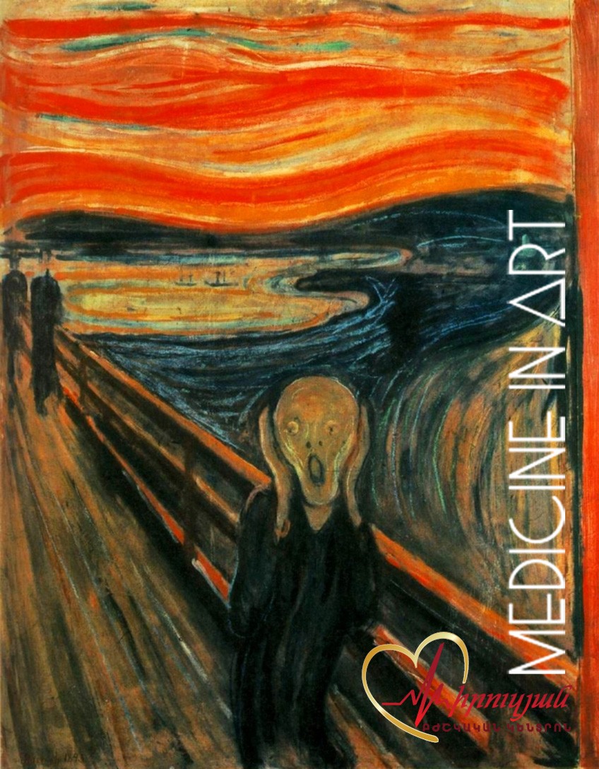 Սպանիչ ֆլու (Spanish Flu) կամ La Grippe